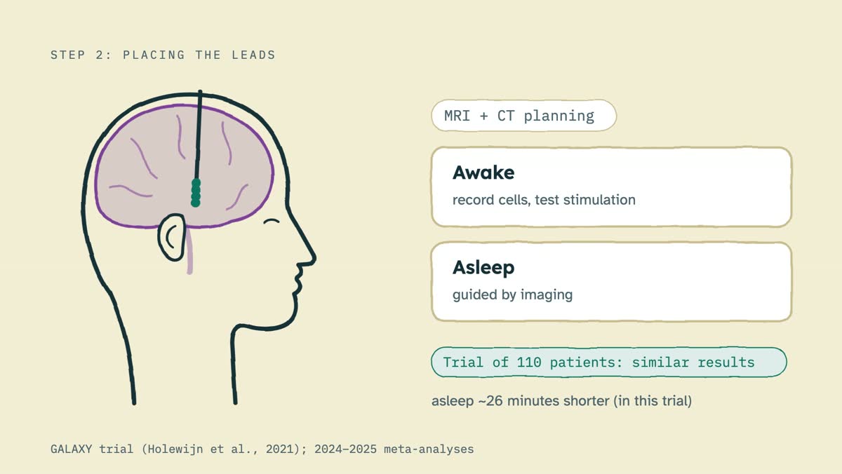 From the video: STEP 2: PLACING THE LEADS, MRI + CT planning, Awake, record cells, test stimulation, Asleep, guided by imaging, Trial of 110 patients: similar results, asleep ~26 minutes shorter (in this trial), GALAXY trial (Holewijn et al., 2021); 2024–2025 meta-analyses