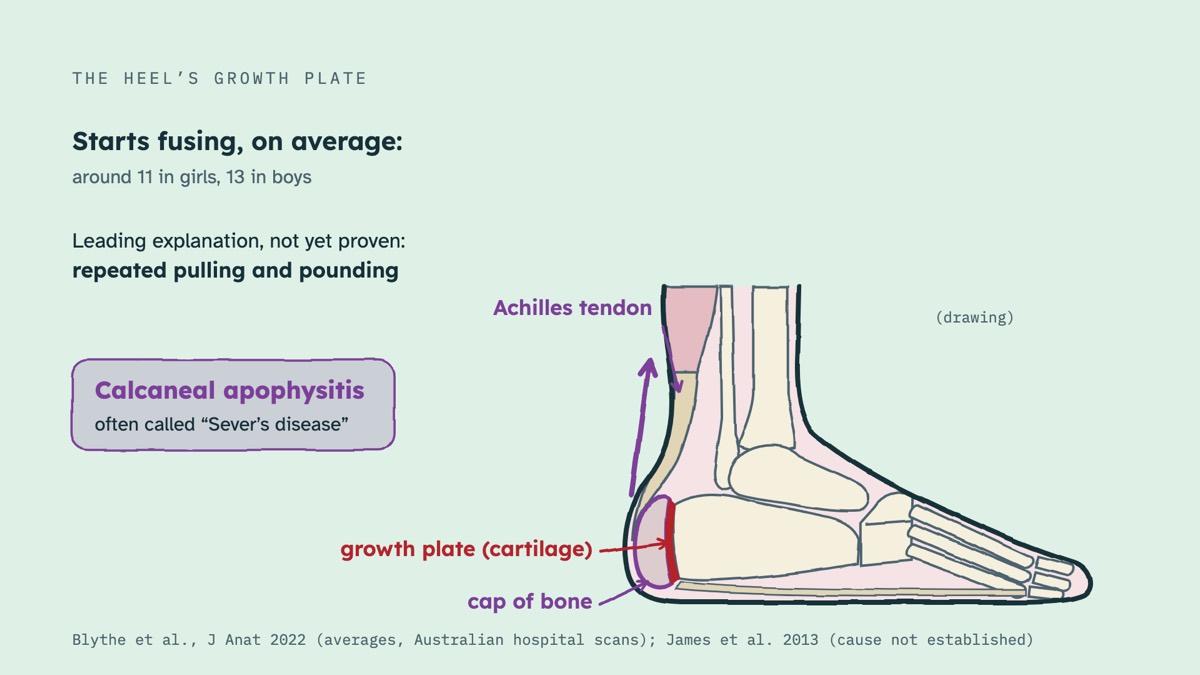 From the video: THE HEEL’S GROWTH PLATE, cap of bone, growth plate (cartilage), Achilles tendon, Starts fusing, on average:, around 11 in girls, 13 in boys, Leading explanation, not yet proven:, repeated pulling and pounding, Calcaneal apophysitis, often called “Sever’s disease”, (drawing), Blythe et al., J Anat 2022 (