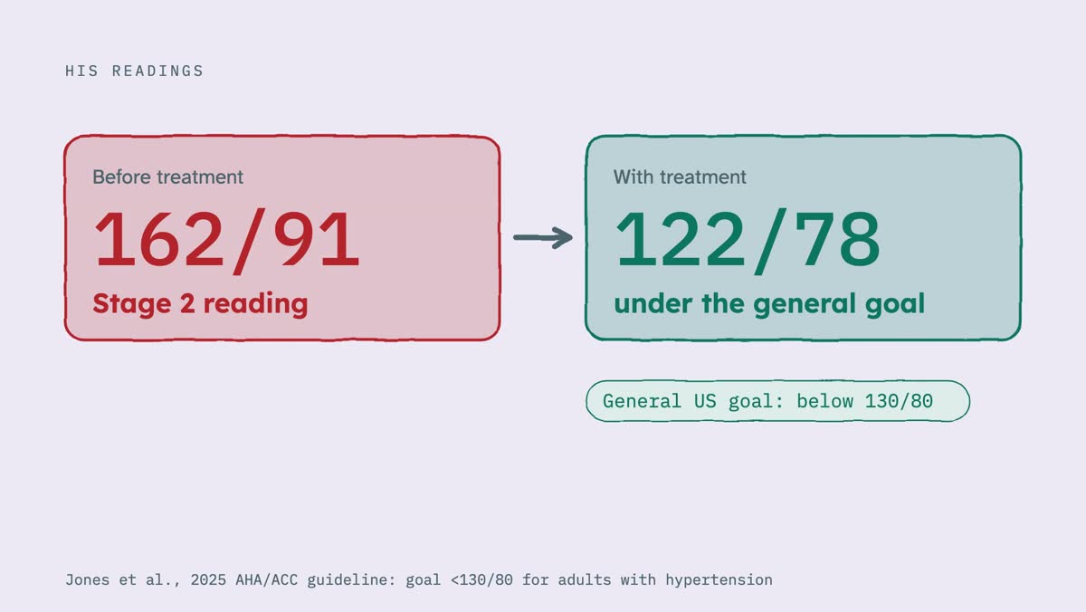 From the video: HIS READINGS, Before treatment, 162/91, Stage 2 reading, With treatment, 122/78, under the general goal, General US goal: below 130/80, Jones et al., 2025 AHA/ACC guideline: goal <130/80 for adults with hypertension